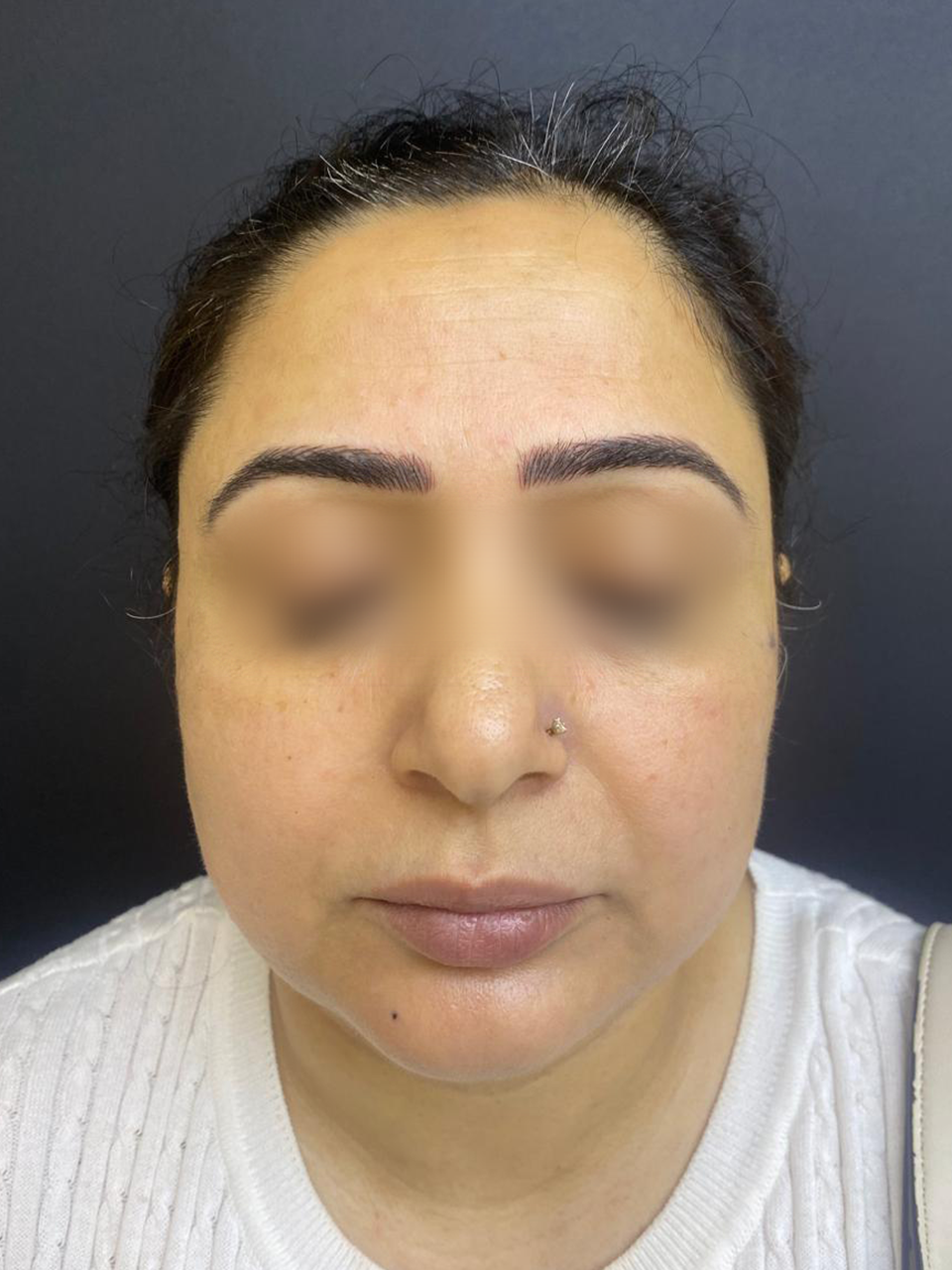 After treatment